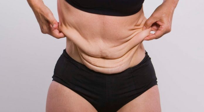 Устранение тугора кожи после похудения и беременности