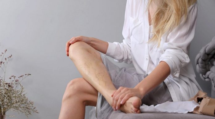 Что представляет собой варикоз и как его побороть