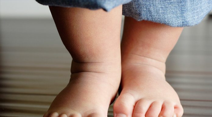 Лечение детской косолапости: комфорт ребенка при ношении брейсов