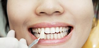 С какими проблемами помогают справиться виниры