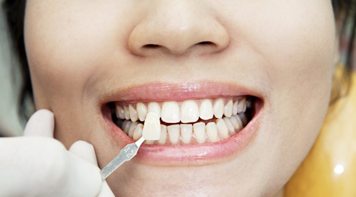 С какими проблемами помогают справиться виниры