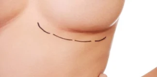 Циркулярная мастопексия: подтяжка грудных желез и удаление излишков кожи