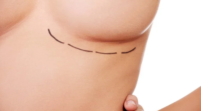 Циркулярная мастопексия: подтяжка грудных желез и удаление излишков кожи