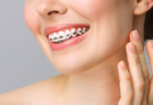 Брекеты под ключ в Москве: эстетика и комфорт в одном решении