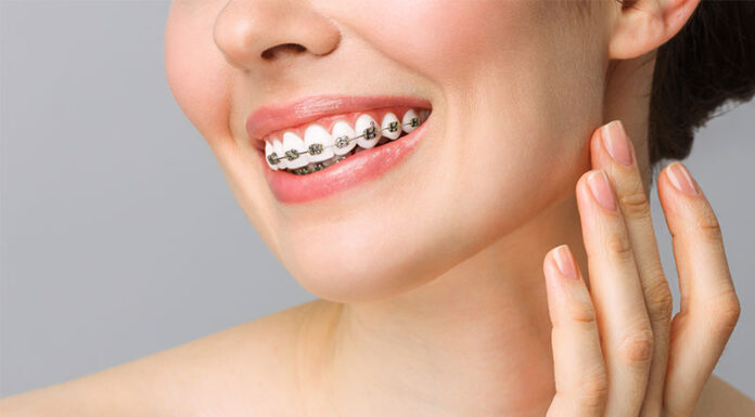 Брекеты под ключ в Москве: эстетика и комфорт в одном решении
