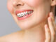 Брекеты под ключ в Москве: эстетика и комфорт в одном решении