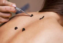 Что такое гирудотерапия: чем она полезна